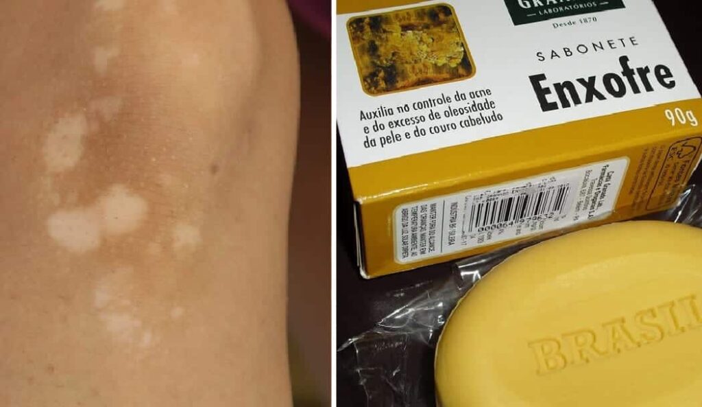 Sabonete de Enxofre para a Pele - Para que serve, Benefícios