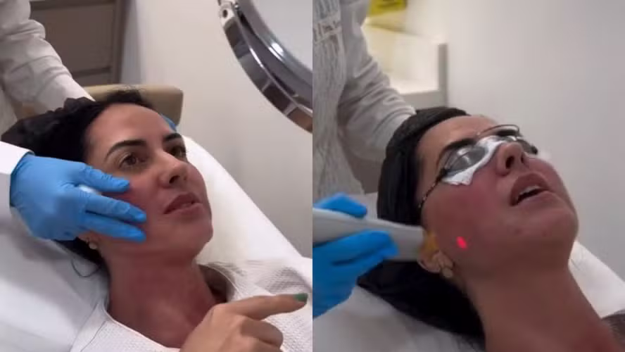 Graciele Lacerda Revela Segredo de Beleza: Procedimentos que Estimulam Colágeno Transformaram seu Rosto